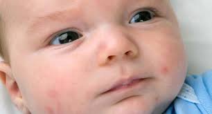 Baby acne
