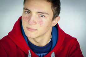 Teens and acnes